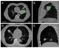 A Genetic Programming Approach to Radiomic-Based Feature Construction for Survival Prediction in Non-Small Cell Lung Cancer