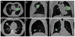 A Genetic Programming Approach to Radiomic-Based Feature Construction for Survival Prediction in Non-Small Cell Lung Cancer